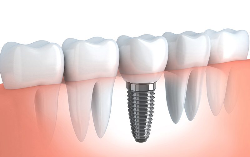 implantologie-Chirurgien-dentiste-Dr-Viviane-Sendroiu-Strasbourg